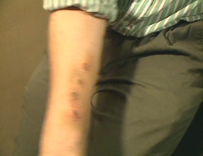 HE SAYS THE POLICE TRIED TO FILL HIS ARM WITH GARLIC.  