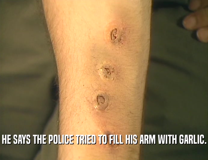 HE SAYS THE POLICE TRIED TO FILL HIS ARM WITH GARLIC.  
