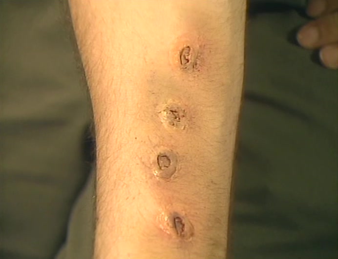 HE SAYS THE POLICE TRIED TO FILL HIS ARM WITH GARLIC.  