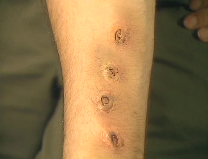 HE SAYS THE POLICE TRIED TO FILL HIS ARM WITH GARLIC.  