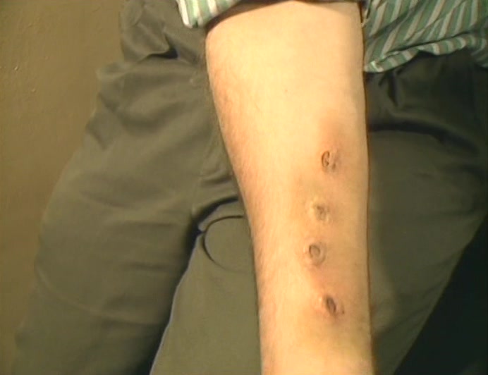 HE SAYS THE POLICE TRIED TO FILL HIS ARM WITH GARLIC.  